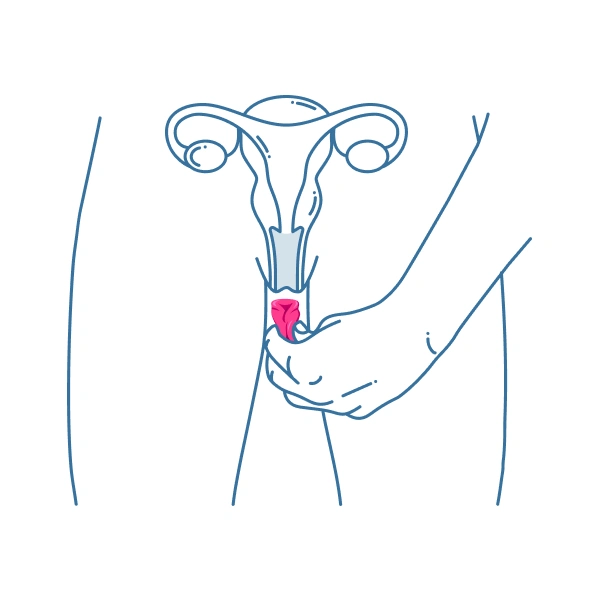 Hand inserting a folded menstrual cup into the vagina