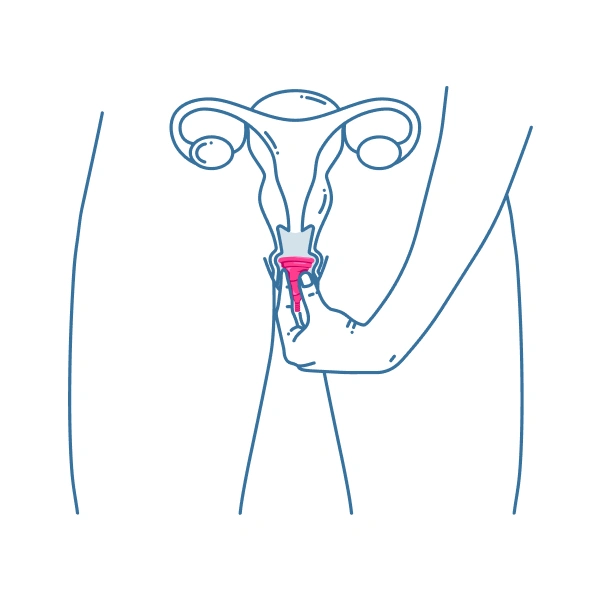 Hand gently removing a menstrual cup from the vaginal canal
